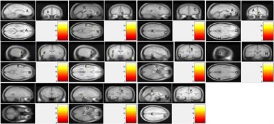 Volumetric Abnormalities in Violent Schizophrenia Patients on the General Psychiatric Ward